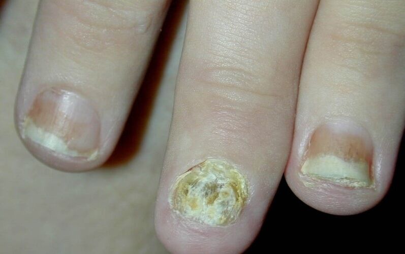 psoriasis on the fingernails