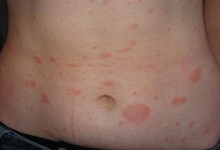 That cure psoriasis in the body