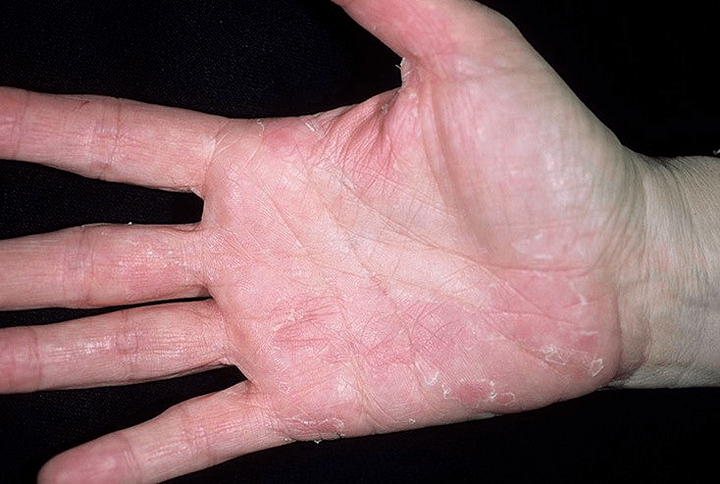 psoriasis of the palms and under