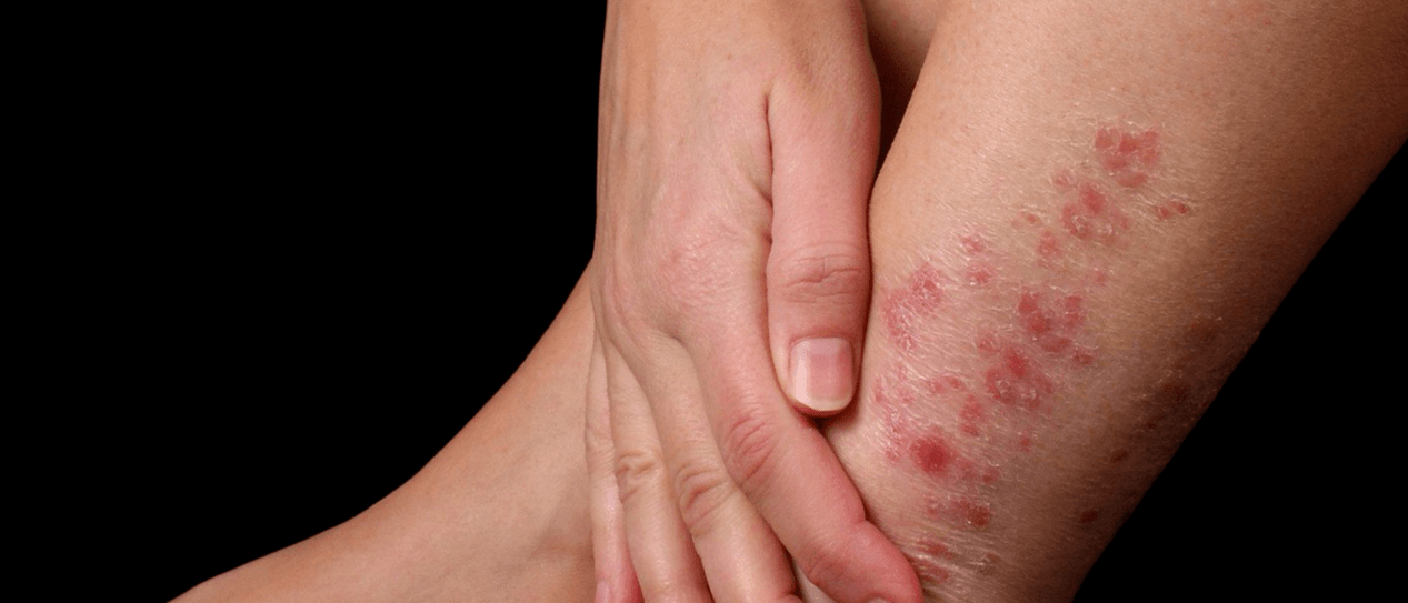 Plaques of psoriasis on the skin of the leg. 