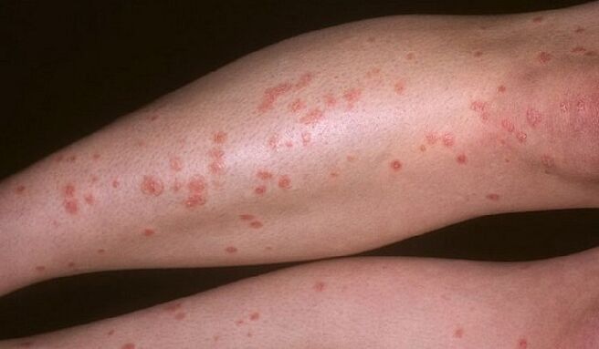 tear-shaped psoriasis on the legs