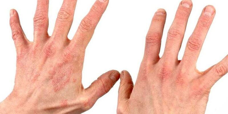 psoriasis on the hands how to treat home remedies