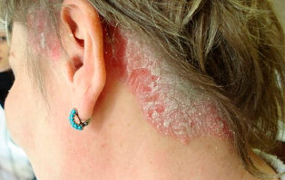 psoriasis-leather-pieces of
