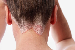 why occurs the psoriasis felt the head