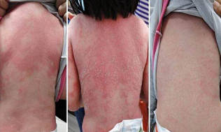 as can be seen psoriasis in children