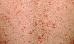 as can be seen psoriasis of the initial phase of