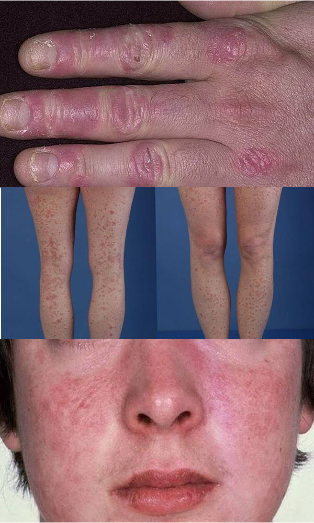 as can be seen psoriasis on the hands and feet in the face