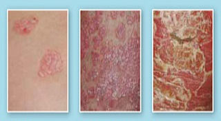 the stage of psoriasis