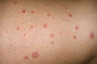 the disease of the symptoms of psoriasis