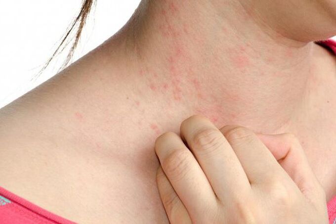 Exacerbation of psoriasis is manifested by skin rashes and severe itching. 