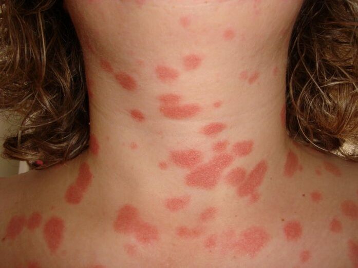 Psoriatic plaques on the skin. 