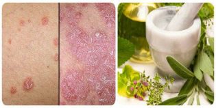 methods of treatment of psoriasis with pills