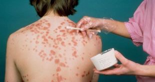methods of treatment of psoriasis