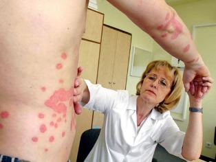 the methods of treatment of psoriasis