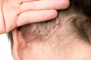 Exacerbation of psoriasis on the head. 