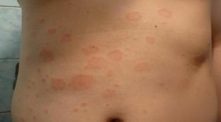 how to recognize the early stage of psoriasis
