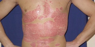 the comprehensive training in the treatment of psoriasis