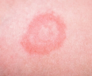The initial stage of psoriasis. 