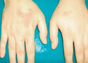 The location of the disease in the hands