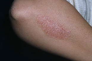 psoriasis of the photo