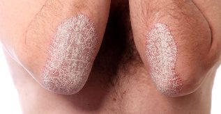 The stage of psoriasis