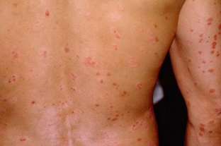 psoriasis of the initial phase of